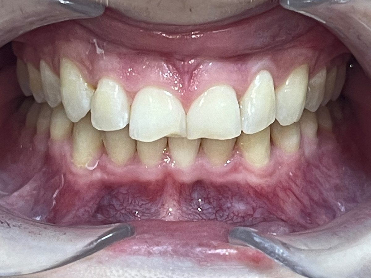 Teeth after clear aligner treatment for angled front teeth and a narrow arch