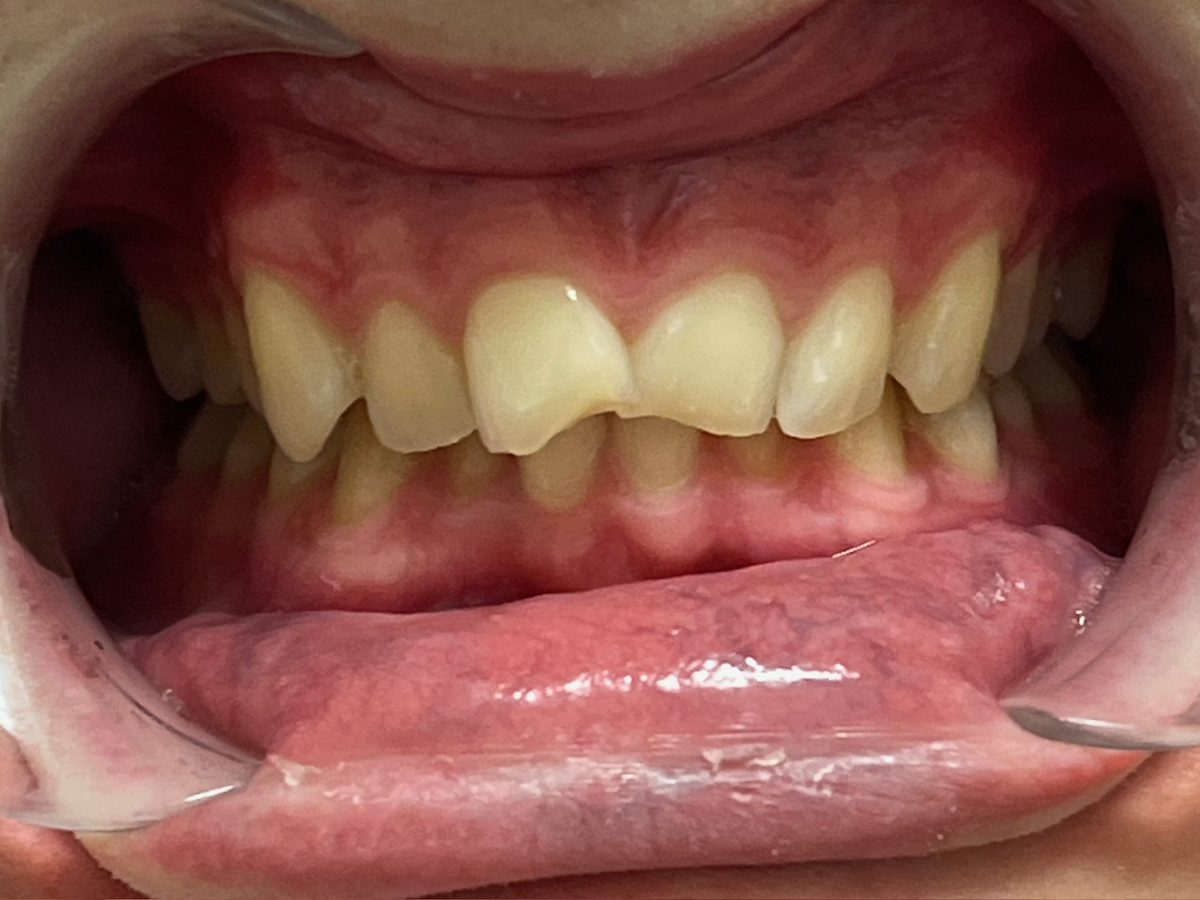 Teeth before clear aligner treatment for angled front teeth and a narrow arch