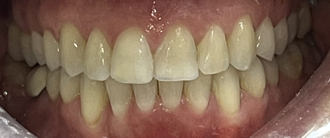 Teeth after clear aligner treatment for crowding and a deep bite