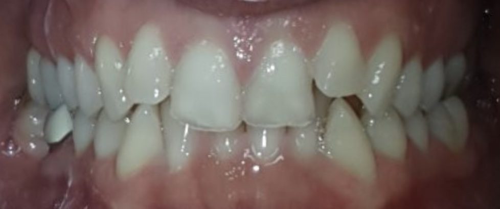 Teeth before clear aligner treatment for crowding and a deep bite