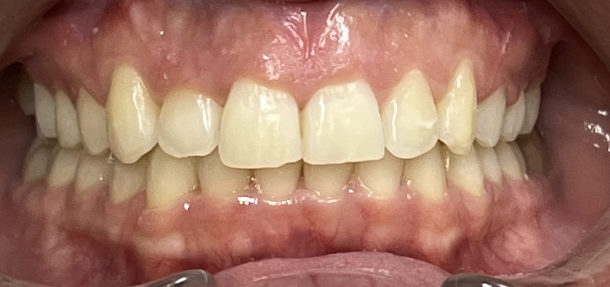 Teeth after clear aligner treatment for a deep bite and displaced side tooth