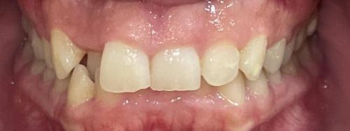 Teeth before clear aligner treatment for a deep bite and displaced side tooth