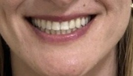 Smile after clear aligner treatment for flared upper front teeth