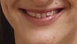 Smile before clear aligner treatment for flared upper front teeth
