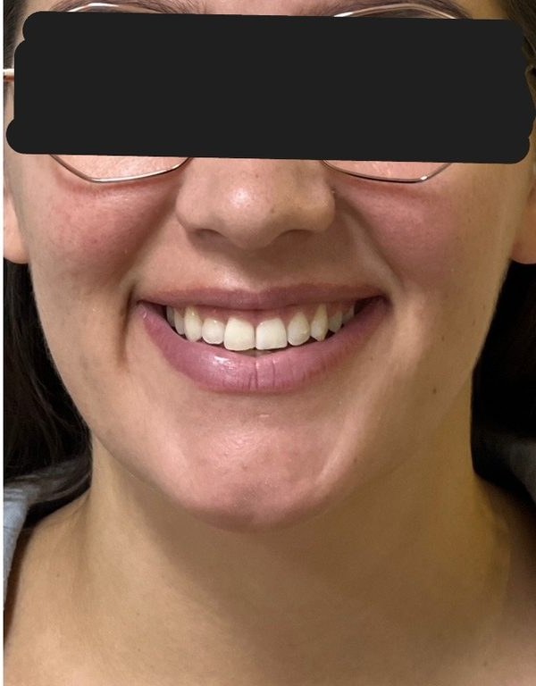After clear aligner treatment for a displaced side tooth