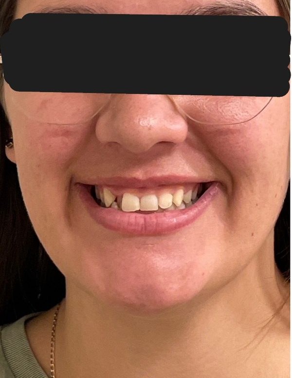 Before clear aligner treatment for a displaced side tooth